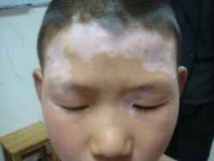 白癜风问答